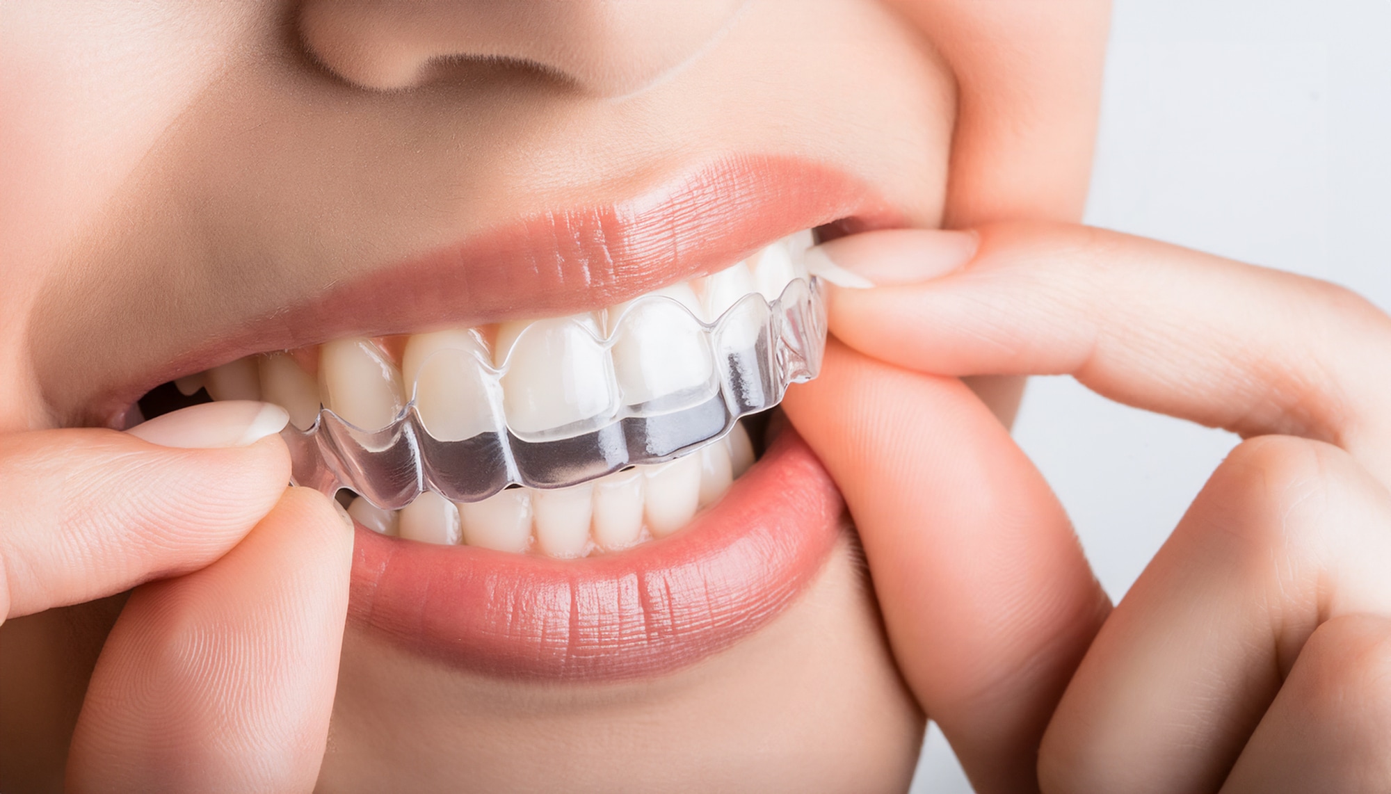 マウスピース矯正の値段や相場は？費用を抑える4つのポイントについてご紹介
