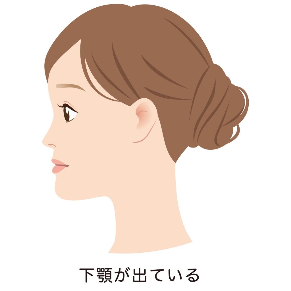 しゃくれや受け口は自分で治せる?原因や放置のリスク、治療法を解説 | 矯正歯科コラム | 湘南美容歯科