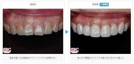 なぜセラミック治療は歯を削る?削る量や治療の流れを解説 | 矯正歯科コラム | 湘南美容歯科
