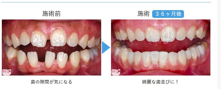 セラミックの症例写真